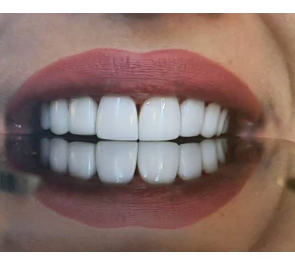 مرکز دندان مصنوعی (پروتز ) دندان در منطقه 22 | کلینیک خیریه الزهرا